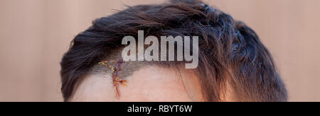 Blessure au crâne avec Suture, fils de couture craniectomy postopératoire avec beaucoup d'agrafes, de la technologie médicale la couture. Banque D'Images