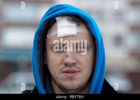 Blessure au crâne avec Suture, fils de couture craniectomy postopératoire avec beaucoup d'agrafes, de la technologie médicale la couture. Banque D'Images