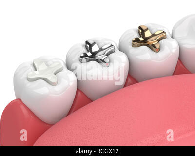 3D render of jaw avec dents et trois types d'incrustation sur fond blanc Banque D'Images