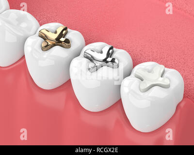 3D render of jaw avec dents et trois types d'incrustation sur fond blanc Banque D'Images