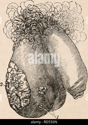 . La cyclopaedia d'anatomie et physiologie. Anatomie ; physiologie ; Zoologie. d'un homme noir, affecté à l'éléphantiasis, tiré de l'œuvre de M. Titley sur » Maladies des organes génitaux, dans l'homme," la tumeur de- gravi presque à la cheville. L'éléphantiasis du scrotum est une affection morbide des téguments, analogue à l'élargissement des extrémités communément connus sous le nom d'Barbadues ; avec la jambe qui, en effet, dans les pays où la maladie est répandue, il est susceptible d'être combiné. L'éléphantiasis du scrotum, cependant, se développe à une plus grande taille et plus rapide rend Banque D'Images