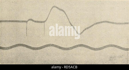 . Elektrophysiologie menschlicher Muskeln. L'électrophysiologie. Abb. 23. DoppoJphasischer Aktionsstroin Unterarmflexoren der. Reizung des Nervus ulnaris dans der biceps- t'urche mit einem Offnungsinduktionsschlag. Erste Kurvenzacke Reizeinbrucli bewirkt durch. Plage Das zwi.schen Reiz und Beginn des Aktionsstromes ist durch zwei senkrechte- abgegrenzt Markierungs striche. Schwingungen Stimmgabel 100 Sekunde pro.. Abb. 24. Wie ABB. 23. Nur wurde der Nervus ulnaris dans Achselhöhle gereizt der. Plage Das zwischen Reiz und Beginn des Aktionsstromes beträchtlich ist größer als dans ABB. 23. Bei di Banque D'Images