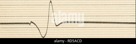 . Elektrophysiologie menschlicher Muskeln. L'électrophysiologie. Abb. 21. AUtionsstroni Eüizelzuckung in pension linortner des Muse. Gastrocncmius der Katze. Elelvtiodendistanz 20 mm. iNach Kohlrausch.i. Abb. 22. Dasselbe. Koter Muse. Le soleus der Katze. Elektrodendistanz 20 mm. Erheblich längere Dauer und größerer Gipfelabstand Stromperiode, der als dans ABB. 21. (Nach Kohl rausch.) abstand aufgenommen sind, ist auch hier das Verhältnis par 4:3. Der Wellenlängenunterschied beträcht- ist aber noch größer-liche. Das Verhältnis ist hier par 3:2. Die Trägheit relative der Roten Muskeln kommt in diesen moi aussi Banque D'Images