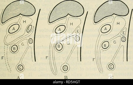 . Cunningham's Text-book de l'anatomie. L'anatomie. Le mésentère Rectum^ mésentère de côlon descendant Fig. 974.-Deux des diagrammes pour illustrer le développement de l'mésentères. Dans la première figure la rotation de l'anse intestinale et le mésentère primitif continue est illustré. Dans la deuxième figure (à droite), qui montre un stade plus avancé, les parties du mésentère primitif (aller à la montée et descente des deux-points) qui dis- paraître, grâce à leur adhésion à la paroi abdominale postérieure, sur fond noir ; les parties qui subsistent sont légèrement ombragés. Il semble que le Banque D'Images