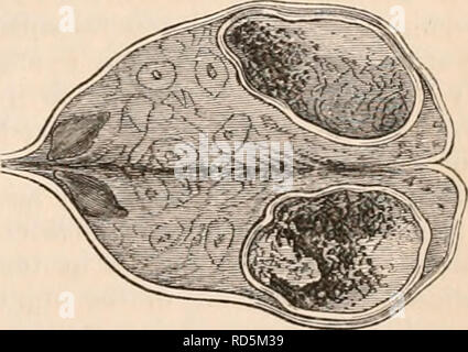 . La cyclopaedia d'anatomie et physiologie. Anatomie ; physiologie ; Zoologie. - L'OVAIRE (anatomie anormale). Le parenchyme, ou aux murs des follicules, particulier ou peuvent affecter toutes ces pièces ensemble. Hyperémie des follicules particulier, avec con- siderable élargissement de la CSC et effusion de sang dans la cavité de la follicule, n'est pas rare observé comme une condition anormale. Mais de l'hyperhémie follicules unique avec effusion de sang dans la cavité a été déjà décrite, comme étant aussi un état naturel du follicule de Graaf, qui se prépare à clehiscence et de décharge Banque D'Images