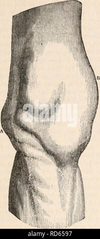 . La cyclopaedia d'anatomie et physiologie. Anatomie ; physiologie ; Zoologie. CONDITIONS ANORMALES DU GENOU. Fig. 2. Gratuit§- 3- 59. Genou gauche, vue de face. Le gonflement proéminent sur la gauche, une, est de l'en- laryed la tête du tibia ; celle de droite, B, est le gonflement globuleux doux résultant de l'effusion dans la membrane synoviale. p. et projection de l'intérieur de la marge du condyle tibia : il se penche sur la face interne du muscle ischio-jambiers. Le reste de l'espace poplité sents avant une apparence normale. Lorsque le membre est en extension complète, et les muscles sont autorisés à rester dans une attitude passive Banque D'Images