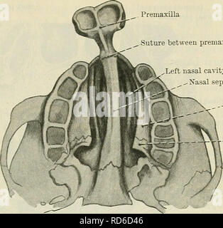 . Cunningham's Text-book de l'anatomie. L'anatomie. -Le visage. 1381 entre la suture prémaxillaire vomer et la cavité nasale gauche ., Xasal septum. Processus palatin de plaque horizontale .maxillaire du palais bone Fig. 1082. - Montre la disposition des os de la double fente palatine {Guide de chirurgie pratique, Bergmann, les sons, et de Mikulicz vomer.) (Fig. 1082). Si la projection prémaxillaires être supprimée, il n'y a plus rien à l'appui de la lèvre supérieure, et le résultat est un vilain défaut de forme, en raison de la saillie comparatif et la redondance de la lèvre inférieure. /^^k f 1£   . Dents prémaxillaire. -Les dents de lait commencent Banque D'Images