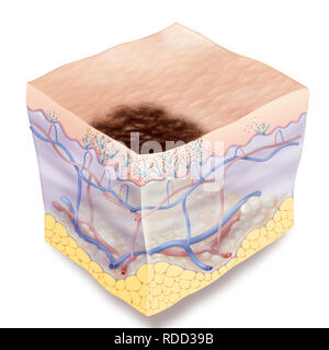 Illustration d'un mélanome de stade 0. Le mélanome a bords dentelés irrégulières. Au stade 0 Il est situé sur l'épiderme. Ce type de cancer de la peau app Banque D'Images