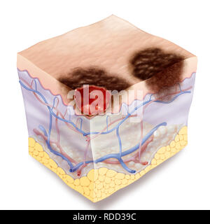 Illustration d'un mélanome de l'étape 1. Le mélanome a bords dentelés irrégulières. Deux types de mélanome de l'étape 1 sont illustrés : à gauche, il est locat Banque D'Images