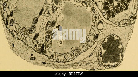 . Les effets de l'inanition et de la malnutrition sur la croissance et la structure. La famine ; la nutrition. mm y. Fig. 114.-une partie d'un article de la thyroïde chez un rat albinos (11,64) tenue à poids constant par alimentation en dessous de 3 à 10 semaines d'âge. Cette zone indique le stade avancé de dégénérescence folliculaire, avec les cellules à divers stades de la dégénérescence et de la désintégration. Il y a un fichier .tendance à la desquamation de l'épithélium, avec destruction de la colloïde et de l'oblitération de la lumière folliculaire. Certains des noyaux apparaissent karyolytic karyopyc, bien qu'identiques- prédomine et karyorrhexis f Banque D'Images