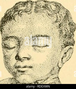 . Les effets de l'inanition et de la malnutrition sur la croissance et la structure. La famine ; la nutrition. io8 INANITION ET DE LA MALNUTRITION. -Jf"**^ y-r I I. ; étude historique des questions concernant l'étiologie du rachitisme a récemment été faite par Park ('23) et par Vaughan ('23). Les droits de rachitisme.-Pour le moment, nous sommes préoccupés par le fait qu'avec les effets plus généraux du rachitisme sur la croissance de l'organisme dans son ensemble, laissant une étude des effets sur le squelette et d'autres organes pour les chapitres suivants. L'apparition du syndrome d'un rachitisme a souvent été revendiquée, mais selon Wieland ('10) il i Banque D'Images