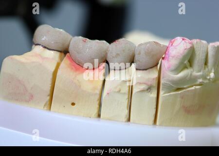 Laboratoire Dentaire, fabrication de prothèses dentaires par un maître artisan, contacts occlusaux, marquée en rouge Banque D'Images