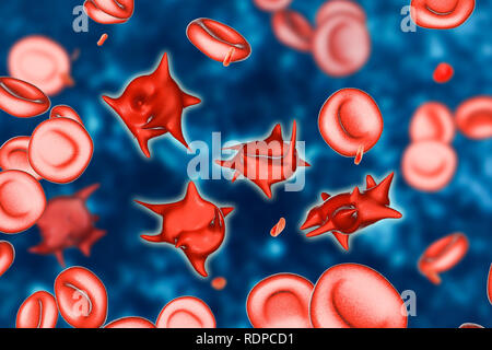 Acanthocytes. Illustration d'anomalies des globules rouges du sang connu sous le nom de cellules épi ou acanthocytes. Les globules rouges avec cette apparence peut survenir en association avec un état rare appelé abetalipoproteinemia, ainsi que pour les maladies du foie, chorée, acanthocytosis a hérité de plusieurs troubles neurologiques, l'anorexie mentale, l'hypothyroïdie, l'alcoolisme, et d'autres troubles. Les cellules déformées sont détruit prématurément, principalement dans la rate, entraînant une anémie. Banque D'Images