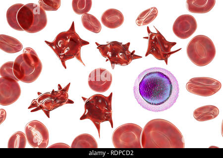 Acanthocytes. Illustration d'anomalies des globules rouges du sang connu sous le nom de cellules épi ou acanthocytes. Les globules rouges avec cette apparence peut survenir en association avec un état rare appelé abetalipoproteinemia, ainsi que pour les maladies du foie, chorée, acanthocytosis a hérité de plusieurs troubles neurologiques, l'anorexie mentale, l'hypothyroïdie, l'alcoolisme, et d'autres troubles. Les cellules déformées sont détruit prématurément, principalement dans la rate, entraînant une anémie. Un petit lymphocyte est dessiné pour la comparaison de taille. Banque D'Images