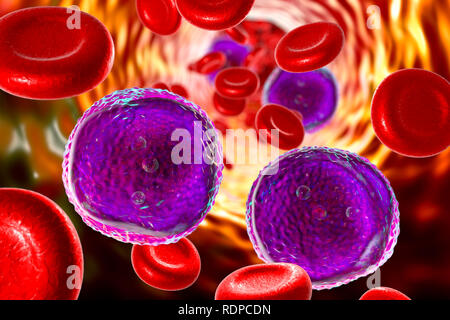 Leucémie aiguë lymphoblastique. Illustration d'ordinateur montrant les cellules lymphoblast abondants dans le sang humain. Banque D'Images