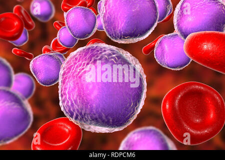 La leucémie aiguë lymphoblastique, frottis de moelle osseuse. Illustration d'ordinateur d'abondantes lymphoblast cellules dans la moelle osseuse humaine. Banque D'Images