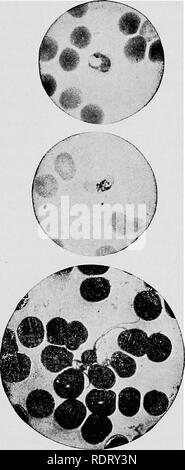 . Éléments de microscopie électronique appliquée. Un texte-livre pour les débutants. Microscopie électronique. Le microscope DE LA MÉDECINE ET DE L'assainissement. 115 La présence dans le sang de la libre "pigment", probablement à partir de matériaux présentant des cellules de sang décomposé ou para- sites, est caractéristique du paludisme.. Fig. 45.-^le parasite du paludisme (vitraux). (Après Slater et Spitta.) 1000 diamètres. 6. L'examen d'expectoration pour le bacille tuberculeux, et le diagnostic de diphtérie culturelles.-Outre les. Veuillez noter que ces images sont extraites de la page numérisée des images qui peuvent avoir été retouchées numériquement pour plus de lisibilité - couleur Banque D'Images