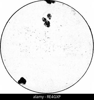 . Les micro-organismes et la maladie. Une introduction à l'étude de certains micro-organismes. Les micro-organismes. Xll] BACILLES PATHOGÈNES : GROUPE C 259 a commencé, et où l'histoire a montré que le pneu- monia était à considérer comme partie intégrante de la maladie et non pas comme une complication secondaire. Alors le résultat de ces examens confirme pleinement les affirmations de Pfeiffer, à savoir, que la caractéristique des bacilles de l'influenza sont constamment présents dans les expectorations bronchiques de. Fig. 97.-Film ecimem Pulhionary Sj'd'Expectoration d'une crise aiguë de Ca^^e de la grippe pneumonie ; noyaux des leucocytes et la ba de l'influenza Banque D'Images