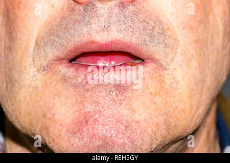 L'herpès sur les lèvres d'un des hommes. L'herpès. lèvres, copy space Banque D'Images
