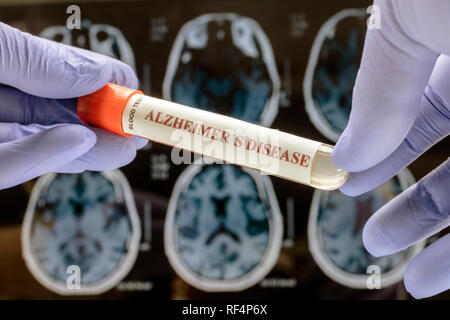 Chercheur scientifique est titulaire d'échantillon de sang d'enquêter sur les recours contre la maladie d'alzheimer, conceptual image Banque D'Images