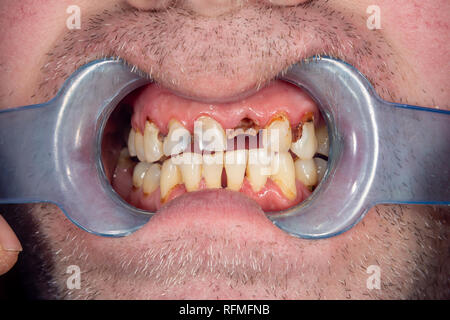 Dents pourries, de la carie et de la plaque dentaire close-up dans un asocially mauvais patient. Le concept d'une mauvaise hygiène et des problèmes de santé Banque D'Images