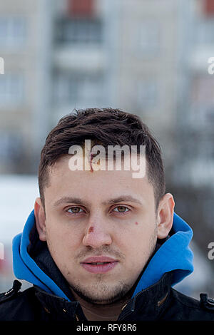 Blessure au crâne avec Suture, fils de couture craniectomy postopératoire avec beaucoup d'agrafes, de la technologie médicale la couture. Banque D'Images