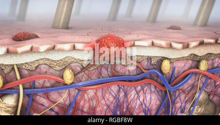 Illustration 3d d'une section d'un mélanome de la peau malade qui entre dans la circulation sanguine et lymphatique intestinal Banque D'Images