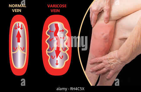 Varices sur une jambe senior femelle Banque D'Images