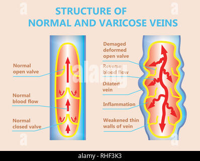 Les varices et les veines normales Banque D'Images