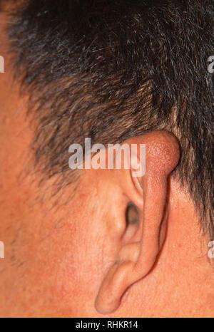 Une chéloïde sur l'oreille gauche d'un homme Banque D'Images