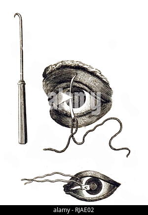 Une gravure représentant une opération pour enlever une cataracte : un crochet a été utilisé pour élever les tissus et l'aiguille filetée insérée. En date du 19e siècle. Banque D'Images
