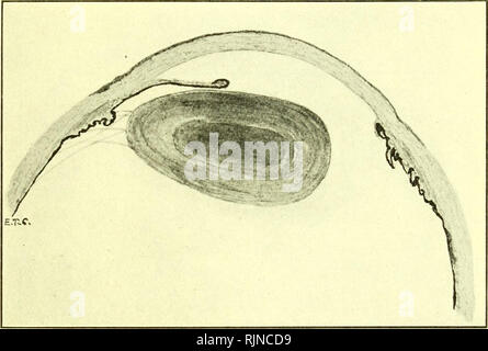 . Pathology and bacteriology [electronic resource]. Ophthalmology; Eye;  Eye; Bacteriology; Ophthalmology; Eye; Bacteriology; Eye. THE CORNEA 559  Tertiary syphilis rarely affects the lids and conjunctiva. Occasionally  gummatous ulcers may form on the