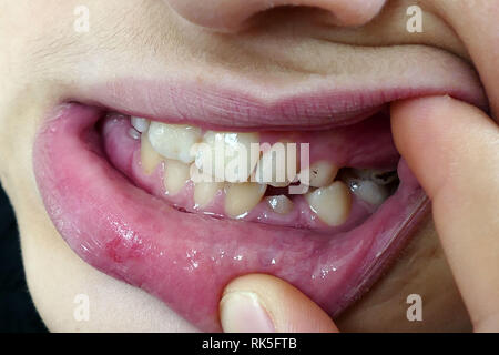 Sante Bucco Dentaire Le Tartre Et Les Taches Noires Sur Les Dents Photo Stock Alamy