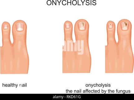 Illustration vecteur de l'infection mycose des ongles, onycholyse Illustration de Vecteur