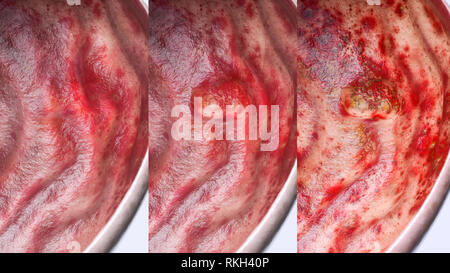 Ulcère gastrique à différents stades- degré de détails - 3D Rendering Banque D'Images