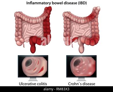 Inflammytory l'intestin medical vector illustration sur fond blanc Illustration de Vecteur
