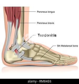 La tendinite de la cheville péronier ,médicale 3d vector illustration Illustration de Vecteur