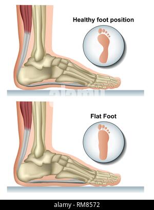 Pied plat vector illustration médicale sur fond blanc Illustration de Vecteur