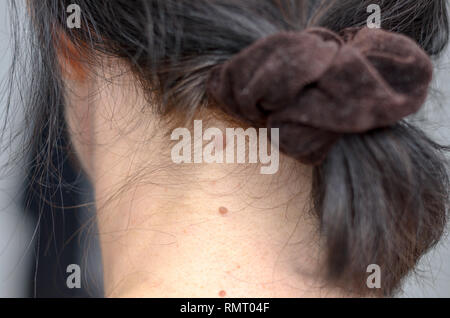 Plan rapproché sur le dos d'une femme sur une femme avec ses cheveux attachés pour révéler trois grains de beauté avec un grand sous sa ligne de cheveux Banque D'Images