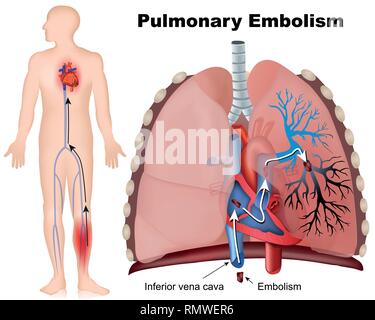 L'embolie pulmonaire vector illustration médicale avec description sur backgrouns blanc Illustration de Vecteur