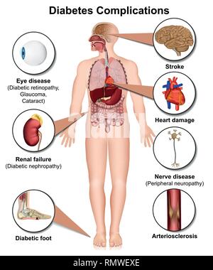 Les complications du diabète et maladies medical illustration vectorielle 3d sur fond blanc Illustration de Vecteur