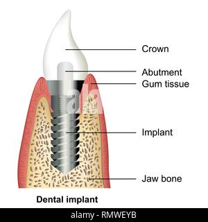 Vector illustration médicale implant dentaire sur fond blanc Illustration de Vecteur
