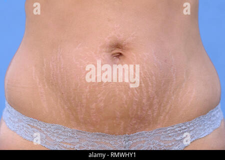 Femme afficher les vergetures sur l'abdomen après grossesse causée par le déchirement de la couche de derme de la peau et montrant que le rouge des décolorations, clo Banque D'Images