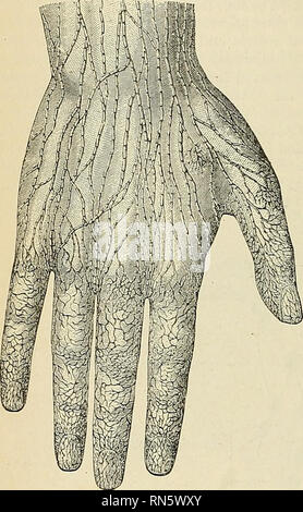 . Anatomie, descriptif et appliquée. L'anatomie. Les SYSTÈMES VASCULAIRES 784 nœuds. Dans l'avant-bras il y a une trentaine de navires, au milieu du bras il n'y a de 15 à 18 ans (Sappey). Les vaisseaux lymphatiques du membre supérieur transmettre la lymphe de l'os, le périoste, muscle, ligament, etc. Ils passent vers le haut de la jambe avec le chef de navires, il y étant généralement deux lignes pour chaque artère. Dans le bras il y a deux ou trois navires. Certains quelques bateaux terminent dans les petits noeuds le long le radial, cubital, et brach- lia les artères, mais la plupart d'entre elles passent directement à la ganglions axillaires. Appliqué Banque D'Images