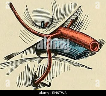 . Anatomie, descriptif et appliquée. L'anatomie. 674 La Direction générale des systèmes d'VASCULAB Le {ramus anterior) en arrière le long des courbes de la bordure interne du foramen obturé, située entre elle et l'obturateur externus muscle ; il distribue des branches pour l'obturateur externus, Pectineus, les adducteurs et gracilis, et avec la direction générale des anastomoses externe et interne, avec l'artère circonflexe. La direction externe {ramus posterior) autour de l'arrière des courbes de la marge extérieure foramen obturé, également située entre le foramen obturé et l'obturateur externus muscle, à l'espace entre la GE Banque D'Images