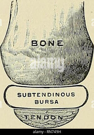 . Anatomie, descriptif et appliquée. L'anatomie. Fig. 214.-Scheme d'une bourse séreuse. (Poirier et Charpj-.) du grand trochanter. Subtendinous bursfe sont souvent trouvés sur les articulations et pas exceptionnellement communiquer directement avec la cavité du joint au moyen d'une ouverture dans la capsule articulaire, la membrane synoviale de l'articulation étant en continuité avec la membrane synoviale de la bourse. Par exemple, la bourse entre le tendon du psoas et des muscles et l'iliacus ligament capsulaire de la hanche communique avec la hanche-joint ; et la bourse entre la surface inférieure du muscle Subscapularis Banque D'Images