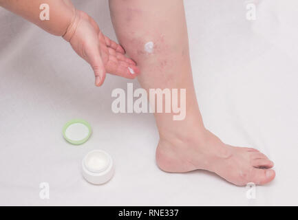 Une femme âgée s'applique à l'onguent de guérison sa jambe sur les varices, jambes, femme phlebeurysm, fond blanc, soin Banque D'Images