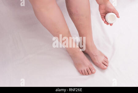 Une femme âgée s'applique à l'onguent de guérison sa jambe sur les varices, jambes, femme phlebeurysm, fond blanc, de la peau, en l'espace de copie, à l'hématologie Banque D'Images