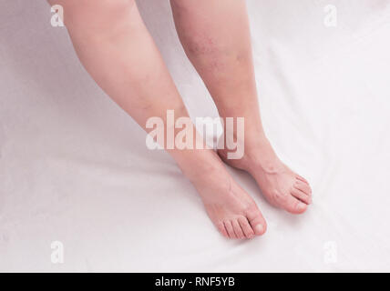 Les jambes d'une vieille femme sur un fond blanc avec des varices sur les jambes, phlebeurysm, veineuse Banque D'Images