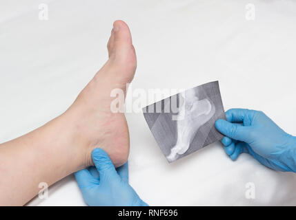 Un médecin de gants médicaux est titulaire d'une radiographie du pied et examine un mal de jambe avec un éperon de talon sur une femme, close-up, ostéophytes et talon, plantar saf Banque D'Images